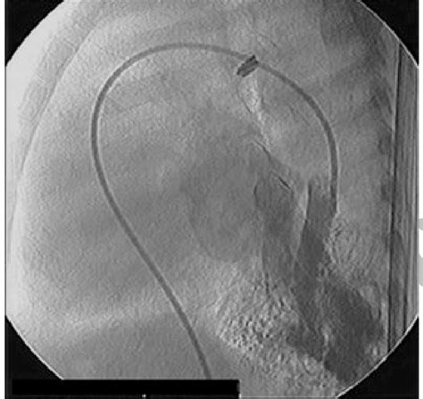 Pulmonary artery angiography of a patient with a large pulmonary... | Download Scientific Diagram