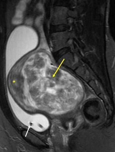 (left): 44 year old nulliparous woman with intramural fibroid and acute... | Download Scientific ...