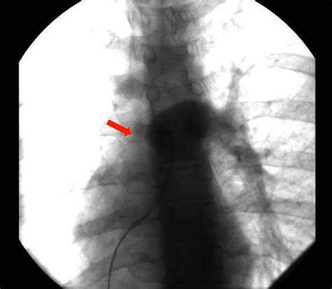 Pulmonary angiography revealing total absence of the right pulmonary... | Download Scientific ...