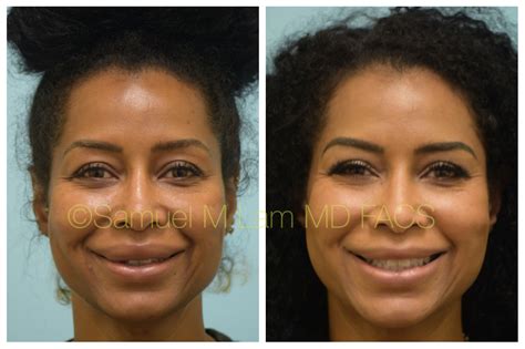 This African-American woman is shown before and 5 months after upper and lower lip reduction to ...