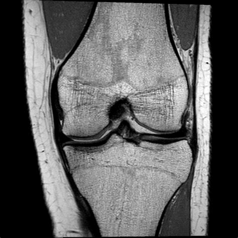 normal knee MRI coronal view 3 Diagram | Quizlet