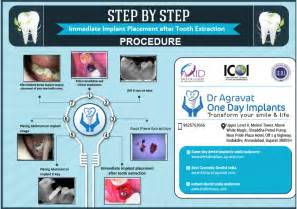 Immediate Implant Placement after Tooth Extraction Procedure & Reviews