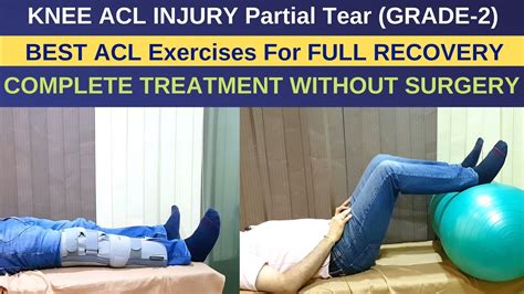 Treatment of ACL Injury Partial Tear-Grade 2, ACL Rehab Exercises Without Surgery- ACL RECOVERY ...