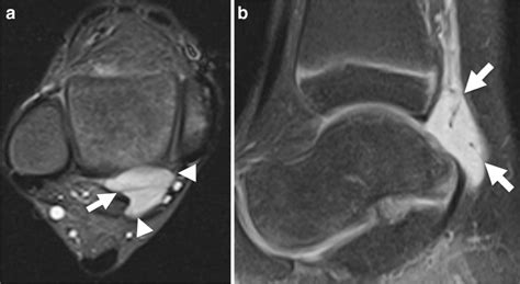 Synovial sarcoma in an 8-year-old girl. a, b MRI. Axial T2-weighted... | Download Scientific Diagram