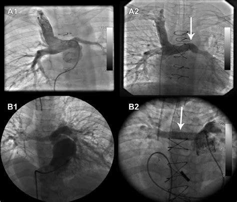 e Representative pulmonary angiography before and after hybrid... | Download Scientific Diagram