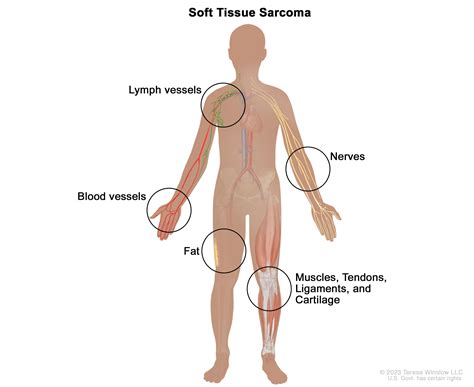 Soft Tissue Sarcoma | UCSF Department of Surgery