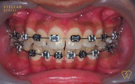 Braces Colors: Top Picks For 2023 - Stellar Dental