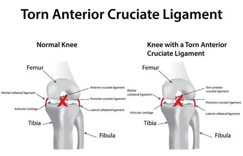 ACL Injury(ACL Tear) – Symptoms and Causes | New Life Ticket - Part 7