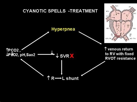 CYANOTIC SPELLS paroxysmal hyperpnea hypoxic spells anoxic spells