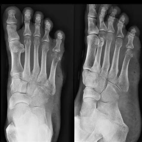 X-ray Left Foot AP/Oblique | Test Price in Delhi | Ganesh Diagnostic