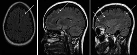 Brain Lesions Mri