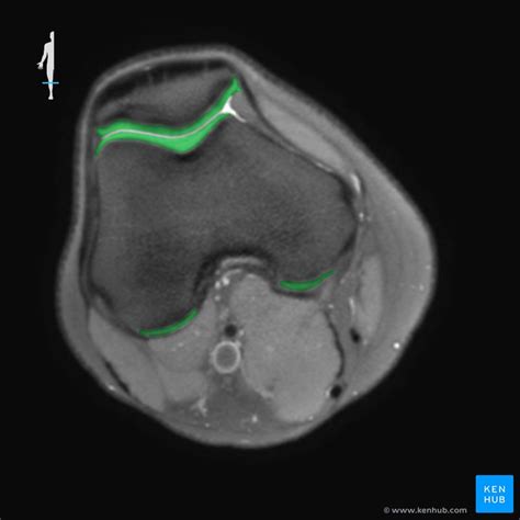 Comandante es inutil Peticionario knee axial mri anatomy ventaja ganador Continuación