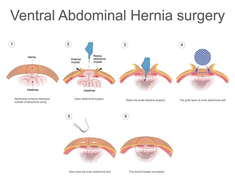 Ventral Hernia repair – GBMC Jordan