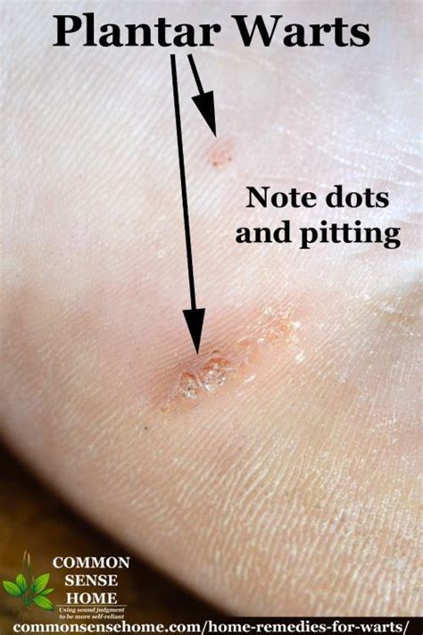 15 Home Remedies for Warts - Easy Home Wart Treatments