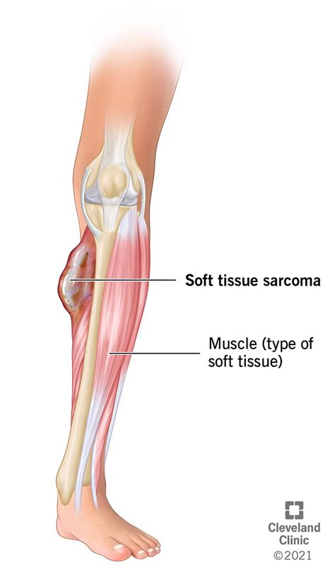 Soft Tissue Sarcoma (Adult): What Is It, Symptoms, Treatment & Outlook