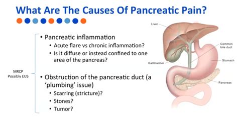 Webinar: Pancreatitis Pain: A Medical Approach with a Patient Focus - Mission: Cure