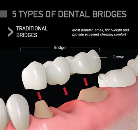 Cantilever Dental Bridge