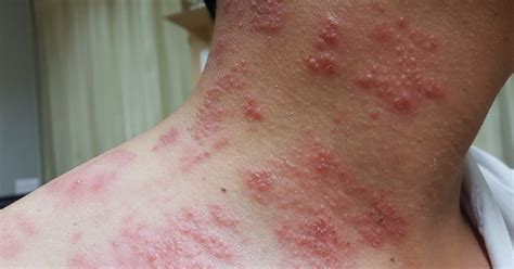 Shingles | STD Concern