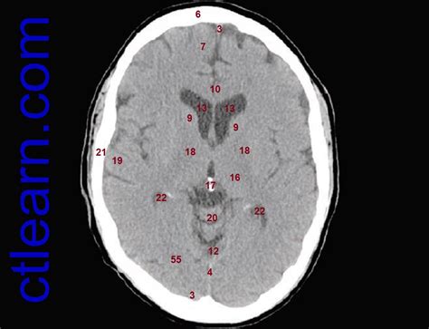 Anatomy CT Axial Brain