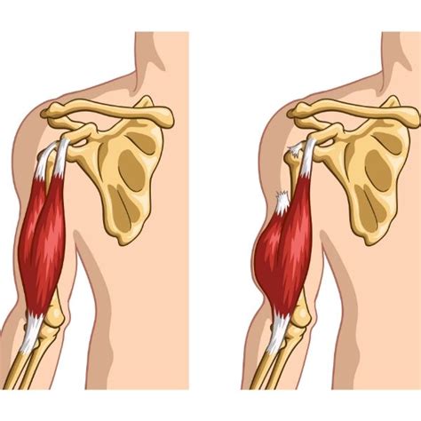 Biceps Tendon Tear and Injury | Shoulder Specialist | South Windsor, Enfield, Glastonbury CT