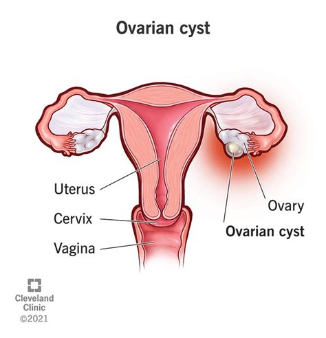 Ovarian Cysts: Causes, Symptoms, Diagnosis & Treatment | Flipboard