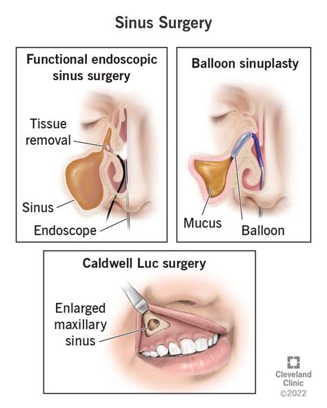 What Causes Swollen Nasal Passages