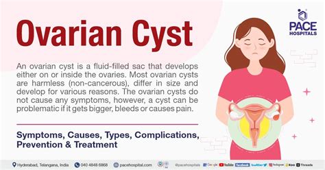 Ovarian cyst - Symptoms, Causes, Types, Complications & Treatment