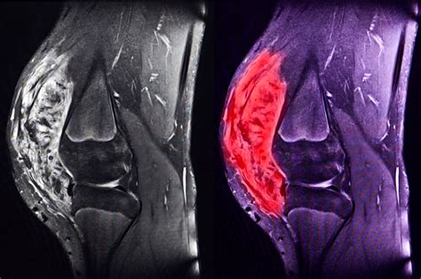 Sarcoma – Greek Cancer care center