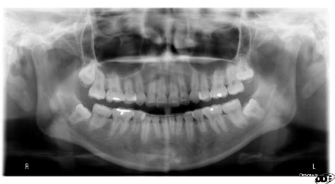 Case of the Week: Taurodontism – Dr. G's Toothpix