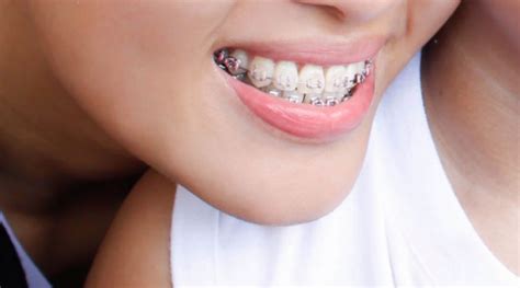 3 BRACES PAIN RELIEF TIPS TO TRY AT HOME - The Smart Blogger