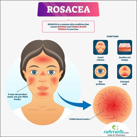 Rosacea: Causes, Symptoms And Treatment | Netmeds