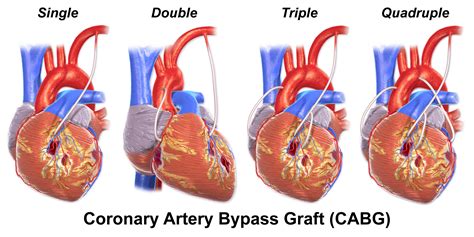 Coronary Artery Disease - CTVSA of Jacksonville, FL