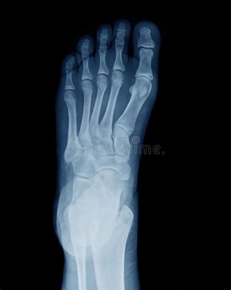 X-ray of foot. X ray of human foot , #SPONSORED, #ray, #foot, #human #ad | Human, X ray, Human foot