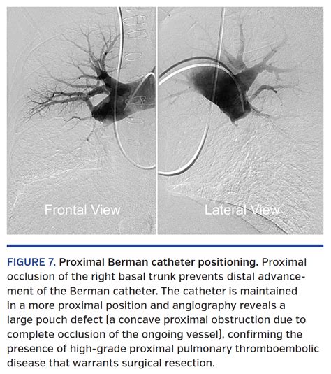 Optimal Technique for Performing Invasive Pulmonary Angiography for Chronic Thromboembolic ...