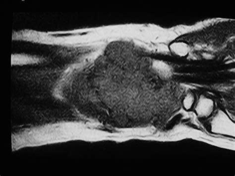 Synovial Sarcoma: Soft Tissue Sarcoma