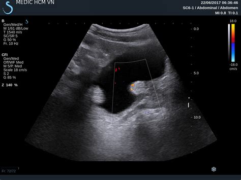 VIETNAMESE MEDIC ULTRASOUND: CASE 439: URINARY BLADDER TUMOR, Dr PHAN THANH HẢI, MEDIC MEDICAL ...