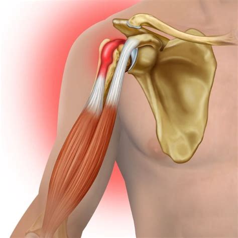 Distal Biceps Tendon Repair | Elbow Surgeon | South Windsor, Rocky Hill Glastonbury CT