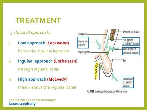 Femoral Hernia Repair Technique