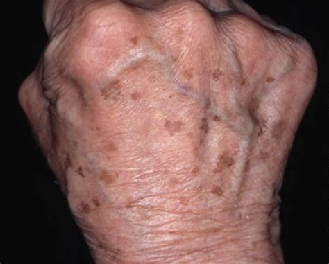 Age Spots - Causes, How To Get Rid, Cream & Treatment