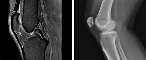 Why Do I Need a Knee MRI? | Wake Radiology UNC REX