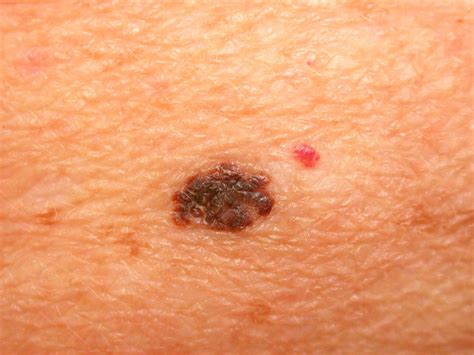 Early-Stage Melanoma: Skin Cancer Treatment