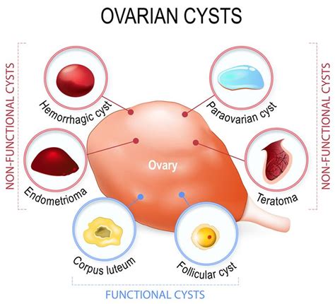 Different Types Ovarian Cyst