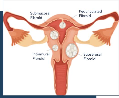 Fibroid Types, Sizes, Location, & FIGO Classifications Explained