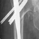 -AO/ASIFClassification Fig 2:-Proximal Femoral Nail | Download Scientific Diagram