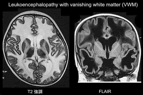 Periventricular White Matter Disease Differential Diagnosis - Pregnant Health Tips