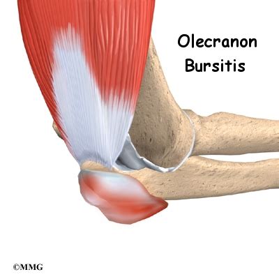 Olecranon Bursitis | Orthogate