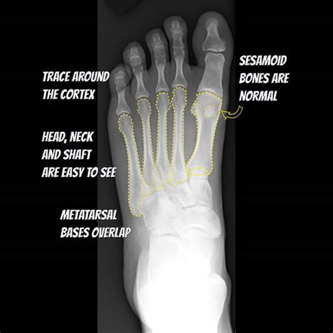 Anatomy Of Foot Bones X Ray : Carpal Bones Anatomy Bone Ray Wrist Tunnel | Digimarketishe Wallpaper