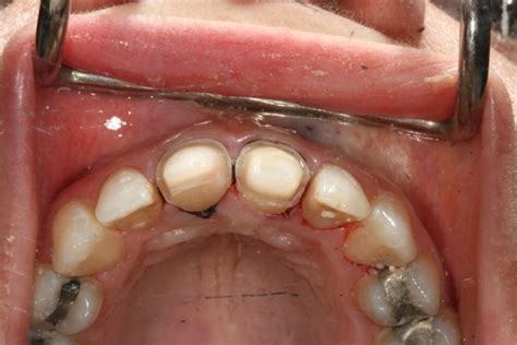 Avoid Cutting the Cingulum from Anterior Teeth | CDOCS