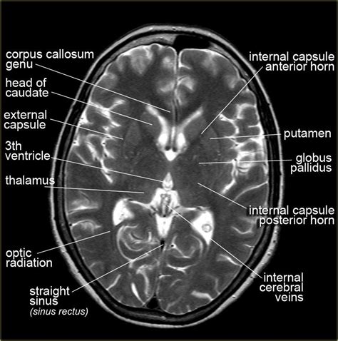 Hippocampus Mri Anatomy