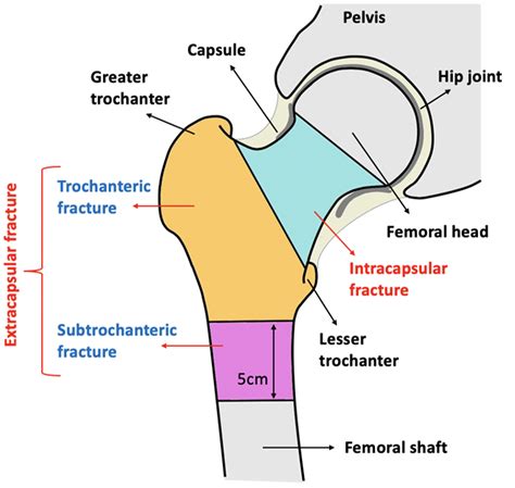 Hip Fracture Types